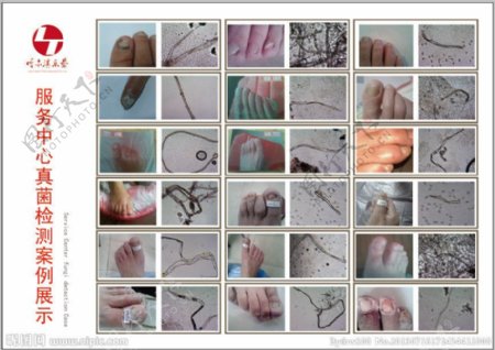 灰指甲菌检图谱图片