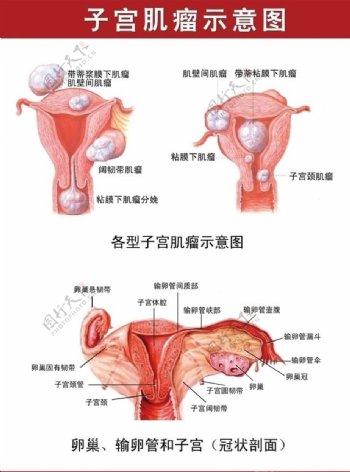 子宫肌瘤示意图图片