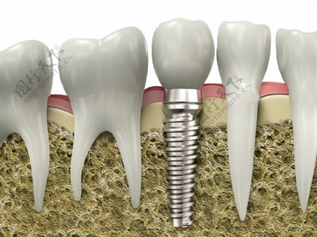 金属牙龈模型图片