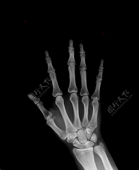 手掌关节X光片图片