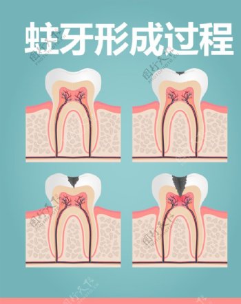 蛀牙的形成过程图片